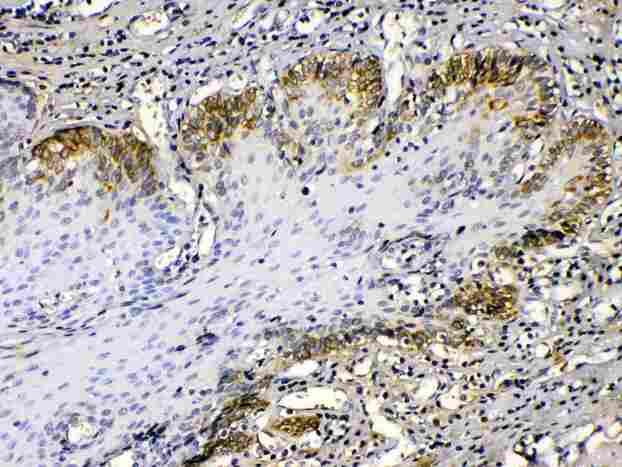 KRT14 / CK14 / Cytokeratin 14 Antibody - Cytokeratin 14 was detected in paraffin-embedded sections of human oesophagus squama cancer tissues using rabbit anti- Cytokeratin 14 Antigen Affinity purified polyclonal antibody