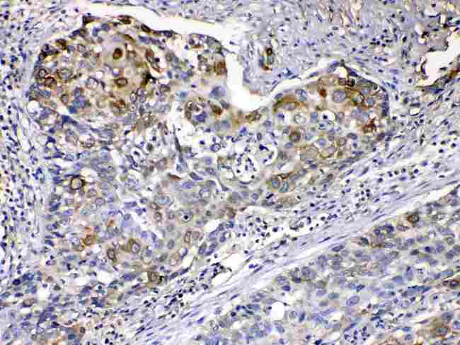 KRT14 / CK14 / Cytokeratin 14 Antibody - Cytokeratin 14 was detected in paraffin-embedded sections of human oesophagus squama cancer tissues using rabbit anti- Cytokeratin 14 Antigen Affinity purified polyclonal antibody