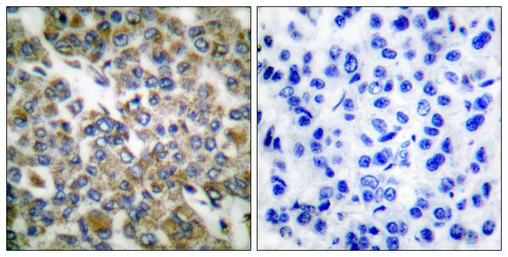 KRT14 / CK14 / Cytokeratin 14 Antibody - Peptide - + Immunohistochemical analysis of paraffin-embedded human breast carcinoma tissue using Keratin 14 antibody.