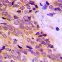 KRT14 / CK14 / Cytokeratin 14 Antibody - Immunohistochemical analysis of Cytokeratin 14 staining in human breast cancer formalin fixed paraffin embedded tissue section. The section was pre-treated using heat mediated antigen retrieval with sodium citrate buffer (pH 6.0). The section was then incubated with the antibody at room temperature and detected using an HRP conjugated compact polymer system. DAB was used as the chromogen. The section was then counterstained with hematoxylin and mounted with DPX.