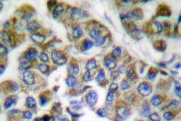 KRT14/KRT16 Antibody - IHC of Cytokeratin 14/16/17 (S5) pAb in paraffin-embedded human breast carcinoma tissue.