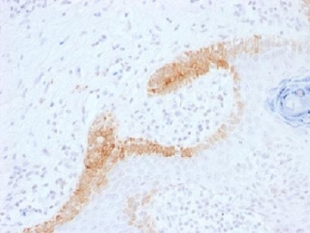 KRT15 / CK15 / Cytokeratin 15 Antibody - IHC testing of FFPE human basal cell carcinoma with Cytokeratin 10 antibody (clone KRT15/1699). Required HIER: boil tissue sections in 10mM citrate buffer, pH 6, for 10-20 min.
