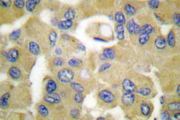 KRT15 / CK15 / Cytokeratin 15 Antibody - IHC of Cytokeratin 15 (T12) pAb in paraffin-embedded human breast carcinoma tissue.