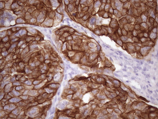 KRT16 / CK16 / Cytokeratin 16 Antibody - Immunohistochemical staining of paraffin-embedded Adenocarcinoma of Human ovary tissue using anti-KRT16 mouse monoclonal antibody. (Heat-induced epitope retrieval by 1 mM EDTA in 10mM Tris, pH8.5, 120C for 3min. (1:150)
