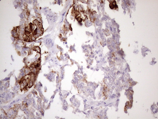 KRT16 / CK16 / Cytokeratin 16 Antibody - Immunohistochemical staining of paraffin-embedded Adenocarcinoma of Human endometrium tissue using anti-KRT16 mouse monoclonal antibody. (Heat-induced epitope retrieval by 1 mM EDTA in 10mM Tris, pH8.5, 120C for 3min. (1:150)