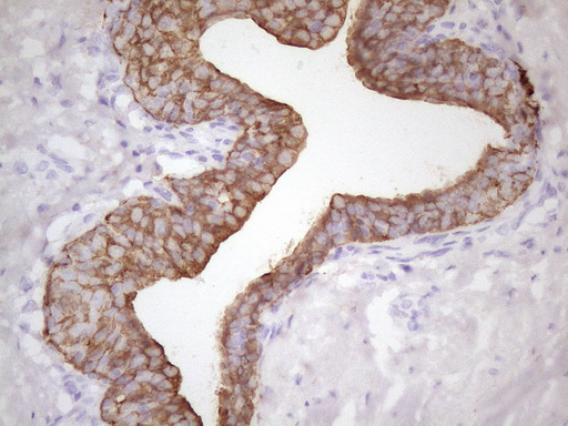 KRT16 / CK16 / Cytokeratin 16 Antibody - Immunohistochemical staining of paraffin-embedded Human prostate tissue within the normal limits using anti-KRT16 mouse monoclonal antibody. (Heat-induced epitope retrieval by 1 mM EDTA in 10mM Tris, pH8.5, 120C for 3min. (1:150)