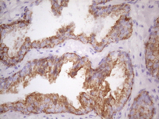 KRT16 / CK16 / Cytokeratin 16 Antibody - Immunohistochemical staining of paraffin-embedded Carcinoma of Human prostate tissue using anti-KRT16 mouse monoclonal antibody. (Heat-induced epitope retrieval by 1 mM EDTA in 10mM Tris, pH8.5, 120C for 3min. (1:150)
