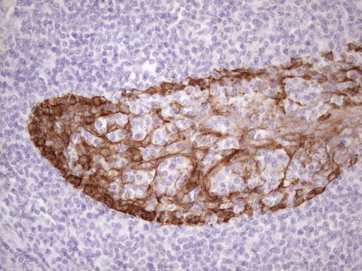 KRT16 / CK16 / Cytokeratin 16 Antibody - Immunohistochemical staining of paraffin-embedded Human tonsil within the normal limits using anti-KRT16 mouse monoclonal antibody. (Heat-induced epitope retrieval by 1 mM EDTA in 10mM Tris, pH8.5, 120C for 3min. (1:150)