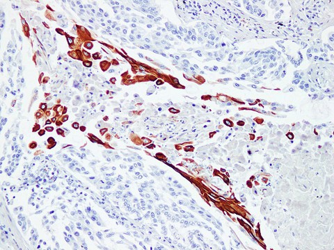 KRT16 / CK16 / Cytokeratin 16 Antibody - Squamous Cell Lung Carcinoma