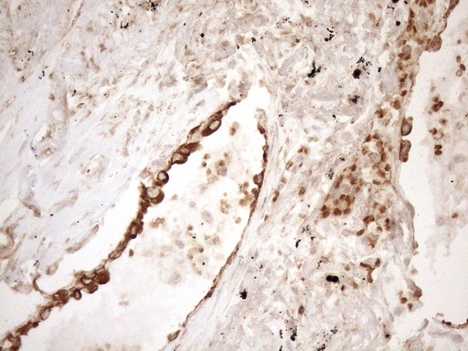 KRT16 / CK16 / Cytokeratin 16 Antibody - Immunohistochemical staining of paraffin-embedded Carcinoma of Human lung tissue using anti-KRT16 mouse monoclonal antibody. (Heat-induced epitope retrieval by 1mM EDTA in 10mM Tris buffer. (pH8.5) at 120°C for 3 min. (1:150)