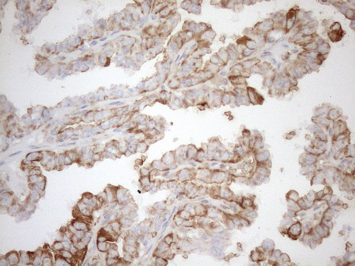 KRT16 / CK16 / Cytokeratin 16 Antibody - Immunohistochemical staining of paraffin-embedded Carcinoma of Human thyroid tissue using anti-KRT16 mouse monoclonal antibody. (Heat-induced epitope retrieval by 1mM EDTA in 10mM Tris buffer. (pH8.5) at 120°C for 3 min. (1:150)