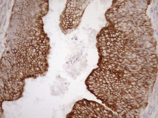 KRT16 / CK16 / Cytokeratin 16 Antibody - Immunohistochemical staining of paraffin-embedded Adenocarcinoma of Human colon tissue using anti-KRT16 mouse monoclonal antibody. (Heat-induced epitope retrieval by 1mM EDTA in 10mM Tris buffer. (pH8.5) at 120°C for 3 min. (1:150)