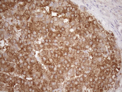 KRT16 / CK16 / Cytokeratin 16 Antibody - Immunohistochemical staining of paraffin-embedded Carcinoma of Human liver tissue using anti-KRT16 mouse monoclonal antibody. (Heat-induced epitope retrieval by 1mM EDTA in 10mM Tris buffer. (pH8.5) at 120°C for 3 min. (1:150)