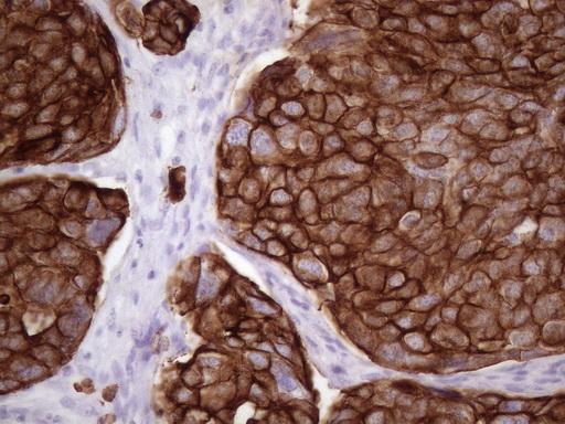 KRT16 / CK16 / Cytokeratin 16 Antibody - Immunohistochemical staining of paraffin-embedded Adenocarcinoma of Human ovary tissue using anti-KRT16 mouse monoclonal antibody. (Heat-induced epitope retrieval by 1 mM EDTA in 10mM Tris, pH8.5, 120C for 3min. (1:150)
