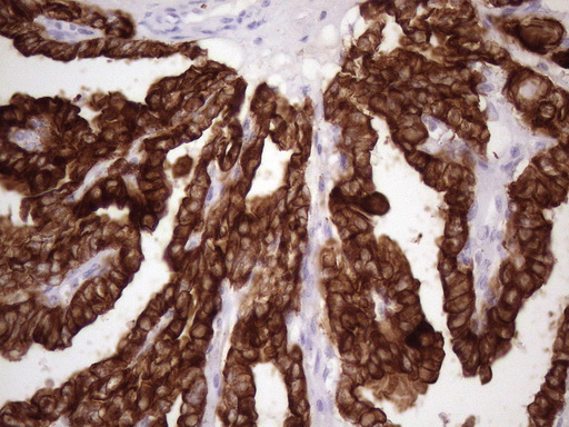 KRT16 / CK16 / Cytokeratin 16 Antibody - Immunohistochemical staining of paraffin-embedded Carcinoma of Human thyroid tissue using anti-KRT16 mouse monoclonal antibody. (Heat-induced epitope retrieval by 1 mM EDTA in 10mM Tris, pH8.5, 120C for 3min. (1:150)