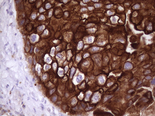 KRT16 / CK16 / Cytokeratin 16 Antibody - Immunohistochemical staining of paraffin-embedded Adenocarcinoma of Human breast tissue using anti-KRT16 mouse monoclonal antibody. (Heat-induced epitope retrieval by 1 mM EDTA in 10mM Tris, pH8.5, 120C for 3min. (1:150)