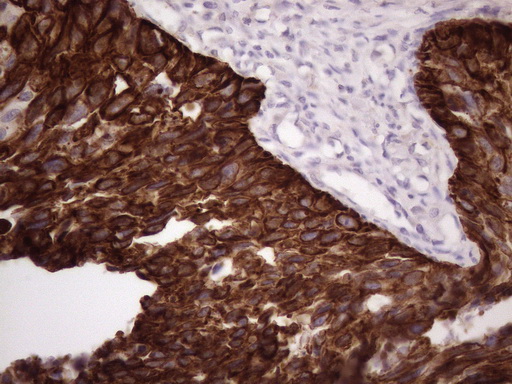 KRT16 / CK16 / Cytokeratin 16 Antibody - Immunohistochemical staining of paraffin-embedded Carcinoma of Human kidney tissue using anti-KRT16 mouse monoclonal antibody. (Heat-induced epitope retrieval by 1 mM EDTA in 10mM Tris, pH8.5, 120C for 3min. (1:150)