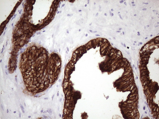 KRT16 / CK16 / Cytokeratin 16 Antibody - IHC of paraffin-embedded Carcinoma of Human prostate tissue using anti-KRT16 mouse monoclonal antibody. (Heat-induced epitope retrieval by 1 mM EDTA in 10mM Tris, pH8.5, 120°C for 3min)(1:150).