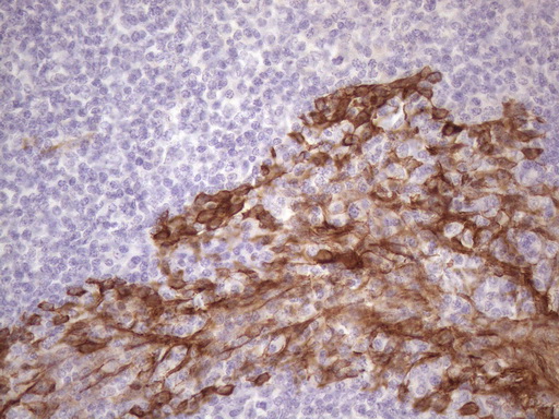 KRT16 / CK16 / Cytokeratin 16 Antibody - IHC of paraffin-embedded Human tonsil using anti-KRT16 mouse monoclonal antibody. (Heat-induced epitope retrieval by 1 mM EDTA in 10mM Tris, pH8.5, 120°C for 3min)(1:150).