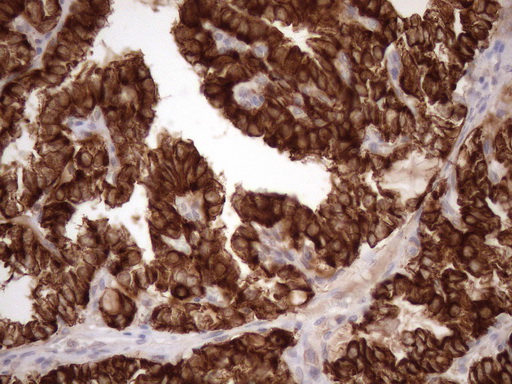 KRT16 / CK16 / Cytokeratin 16 Antibody - Immunohistochemical staining of paraffin-embedded Carcinoma of Human thyroid tissue using anti-KRT16 mouse monoclonal antibody. (Heat-induced epitope retrieval by 1mM EDTA in 10mM Tris buffer. (pH8.5) at 120 oC for 3 min. (1:150)