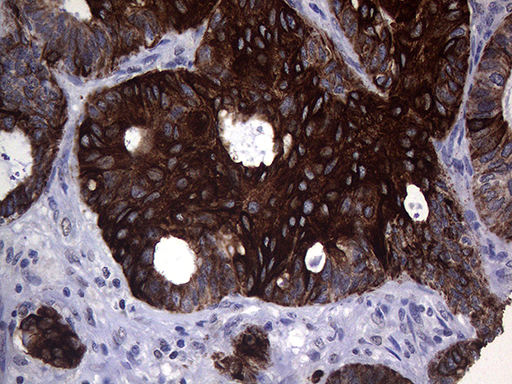 KRT16 / CK16 / Cytokeratin 16 Antibody - Immunohistochemical staining of paraffin-embedded Adenocarcinoma of Human ovary tissue using anti-KRT16 mouse monoclonal antibody. (Heat-induced epitope retrieval by 1mM EDTA in 10mM Tris buffer. (pH8.5) at 120°C for 3 min. (1:2000)