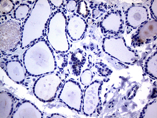 KRT16 / CK16 / Cytokeratin 16 Antibody - Immunohistochemical staining of paraffin-embedded Human thyroid tissue within the normal limits using anti-KRT16 mouse monoclonal antibody.This figure shows negative staining. (Heat-induced epitope retrieval by 1mM EDTA in 10mM Tris buffer. (pH8.5) at 120°C for 3 min. (1:2000)