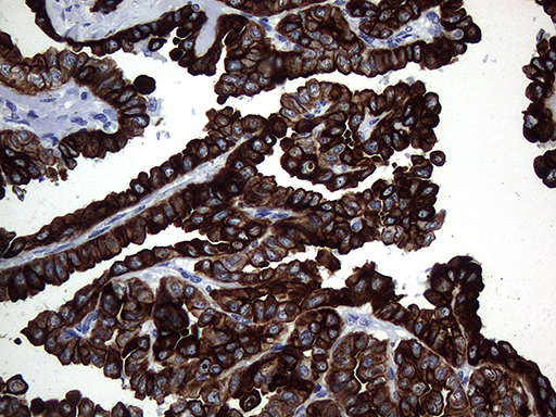KRT16 / CK16 / Cytokeratin 16 Antibody - Immunohistochemical staining of paraffin-embedded Carcinoma of Human thyroid tissue using anti-KRT16 mouse monoclonal antibody. (Heat-induced epitope retrieval by 1mM EDTA in 10mM Tris buffer. (pH8.5) at 120°C for 3 min. (1:2000)