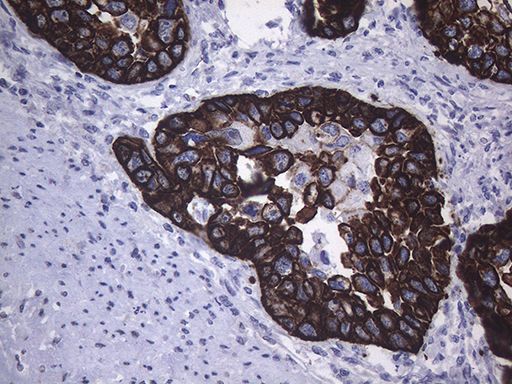 KRT16 / CK16 / Cytokeratin 16 Antibody - Immunohistochemical staining of paraffin-embedded Carcinoma of Human kidney tissue using anti-KRT16 mouse monoclonal antibody. (Heat-induced epitope retrieval by 1mM EDTA in 10mM Tris buffer. (pH8.5) at 120°C for 3 min. (1:2000)
