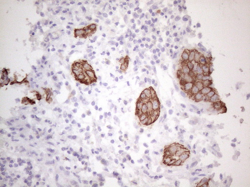 KRT16 / CK16 / Cytokeratin 16 Antibody - Immunohistochemical staining of paraffin-embedded Carcinoma of Human bladder tissue using anti-KRT16 mouse monoclonal antibody. (Heat-induced epitope retrieval by 1mM EDTA in 10mM Tris buffer. (pH8.5) at 120°C for 3 min. (1:150)