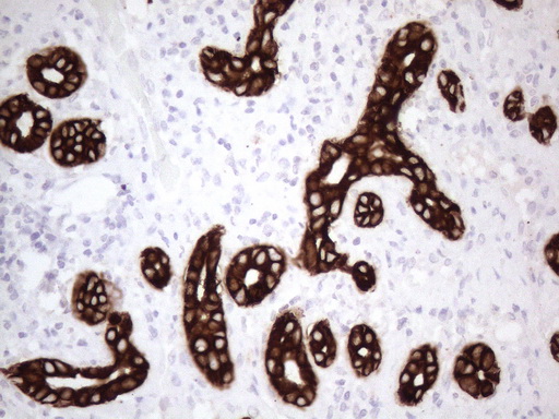 KRT16 / CK16 / Cytokeratin 16 Antibody - Immunohistochemical staining of paraffin-embedded Carcinoma of Human liver tissue using anti-KRT16 mouse monoclonal antibody. (Heat-induced epitope retrieval by 1mM EDTA in 10mM Tris buffer. (pH8.5) at 120°C for 3 min. (1:150)