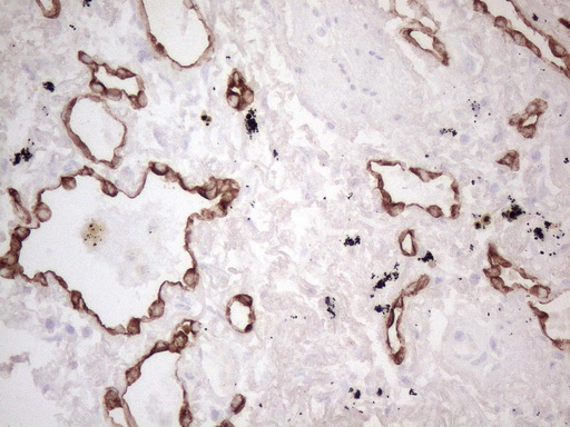 KRT16 / CK16 / Cytokeratin 16 Antibody - Immunohistochemical staining of paraffin-embedded Carcinoma of Human lung tissue using anti-KRT16 mouse monoclonal antibody. (Heat-induced epitope retrieval by 1mM EDTA in 10mM Tris buffer. (pH8.5) at 120°C for 3 min. (1:150)