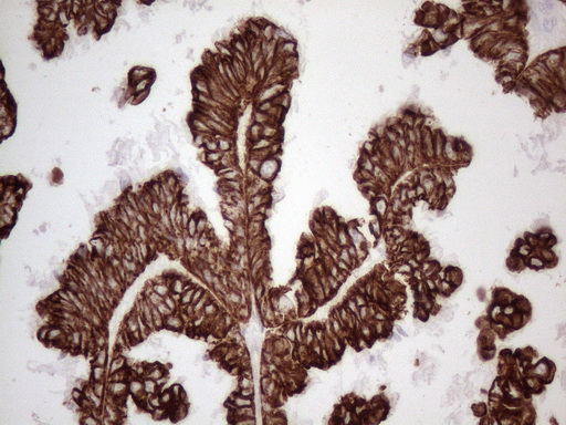 KRT16 / CK16 / Cytokeratin 16 Antibody - Immunohistochemical staining of paraffin-embedded Adenocarcinoma of Human ovary tissue using anti-KRT16 mouse monoclonal antibody. (Heat-induced epitope retrieval by 1mM EDTA in 10mM Tris buffer. (pH8.5) at 120°C for 3 min. (1:150)