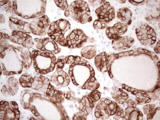 KRT16 / CK16 / Cytokeratin 16 Antibody - Immunohistochemical staining of paraffin-embedded Human thyroid tissue within the normal limits using anti-KRT16 mouse monoclonal antibody. (Heat-induced epitope retrieval by 1mM EDTA in 10mM Tris buffer. (pH8.5) at 120°C for 3 min. (1:150)