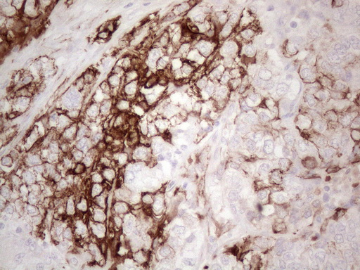 KRT16 / CK16 / Cytokeratin 16 Antibody - Immunohistochemical staining of paraffin-embedded Adenocarcinoma of Human endometrium tissue using anti-KRT16 mouse monoclonal antibody. (Heat-induced epitope retrieval by 1mM EDTA in 10mM Tris buffer. (pH8.5) at 120°C for 3 min. (1:150)