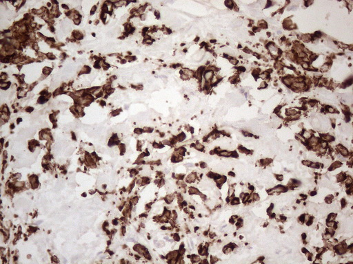 KRT16 / CK16 / Cytokeratin 16 Antibody - Immunohistochemical staining of paraffin-embedded Adenocarcinoma of Human breast tissue using anti-KRT16 mouse monoclonal antibody. (Heat-induced epitope retrieval by 1mM EDTA in 10mM Tris buffer. (pH8.5) at 120°C for 3 min. (1:150)