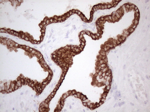KRT16 / CK16 / Cytokeratin 16 Antibody - Immunohistochemical staining of paraffin-embedded Carcinoma of Human prostate tissue using anti-KRT16 mouse monoclonal antibody. (Heat-induced epitope retrieval by 1mM EDTA in 10mM Tris buffer. (pH8.5) at 120°C for 3 min. (1:150)