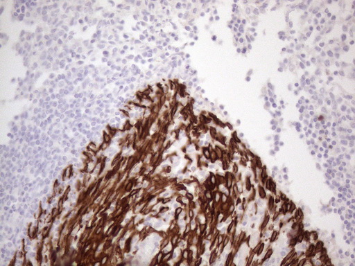 KRT16 / CK16 / Cytokeratin 16 Antibody - Immunohistochemical staining of paraffin-embedded Human tonsil within the normal limits using anti-KRT16 mouse monoclonal antibody. (Heat-induced epitope retrieval by 1mM EDTA in 10mM Tris buffer. (pH8.5) at 120°C for 3 min. (1:150)