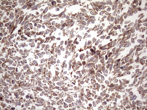 KRT16 / CK16 / Cytokeratin 16 Antibody - Immunohistochemical staining of paraffin-embedded Human melanoma tissue using anti-KRT16 mouse monoclonal antibody. (Heat-induced epitope retrieval by 1mM EDTA in 10mM Tris buffer. (pH8.5) at 120 oC for 3 min. (1:150)