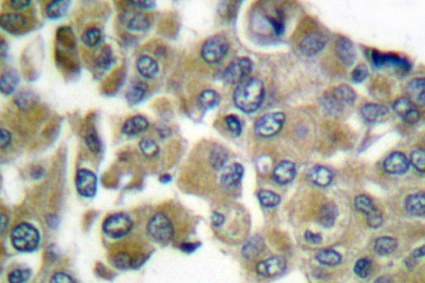 KRT16 / CK16 / Cytokeratin 16 Antibody - IHC of Cytokeratin 16 (S451) pAb in paraffin-embedded human breast carcinoma tissue.