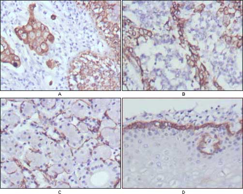 KRT17 / CK17 / Cytokeratin 17 Antibody - IHC of paraffin-embedded human lung cancer (A), endometrial carcinoma (B), sublingual gland (C) and esophagus (D) tissues using CK17 mouse monoclonal antibody with DAB staining.