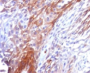 KRT17 / CK17 / Cytokeratin 17 Antibody - IHC testing of FFPE cervical carcinoma and Cytokeratin 17 antibody (clone CTKN17-1).  This image was taken for the unmodified form of this product. Other forms have not been tested.
