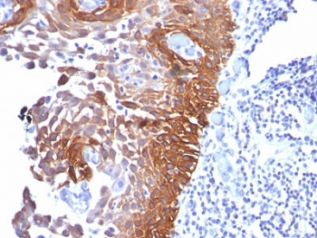 KRT17 / CK17 / Cytokeratin 17 Antibody - IHC staining of FFPE human cervical carcinoma with Cytokeratin 17 antibody (clone E3).