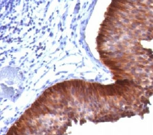 KRT17 / CK17 / Cytokeratin 17 Antibody - IHC staining of FFPE human bladder carcinoma with Cytokeratin 17 antibody (clone E3).