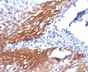 KRT17 / CK17 / Cytokeratin 17 Antibody - Formalin-fixed, paraffin-embedded human cervical carcinoma stained with Cytokeratin 17 antibody (KRT17/778).  This image was taken for the unmodified form of this product. Other forms have not been tested.
