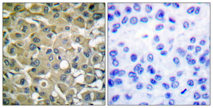 KRT18 / CK18 / Cytokeratin 18 Antibody - Immunohistochemistry analysis of paraffin-embedded human breast carcinoma tissue, using Keratin 18 Antibody. The picture on the right is blocked with the synthesized peptide.