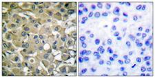 KRT18 / CK18 / Cytokeratin 18 Antibody - Immunohistochemistry analysis of paraffin-embedded human breast carcinoma tissue, using Keratin 18 Antibody. The picture on the right is blocked with the synthesized peptide.