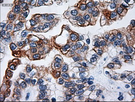 KRT18 / CK18 / Cytokeratin 18 Antibody - IHC of paraffin-embedded Carcinoma of liver using anti-KRT18 mouse monoclonal antibody.