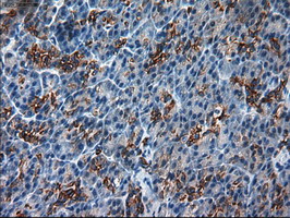 KRT18 / CK18 / Cytokeratin 18 Antibody - IHC of paraffin-embedded Carcinoma of pancreas using anti-KRT18 mouse monoclonal antibody.
