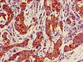 KRT18 / CK18 / Cytokeratin 18 Antibody - Immunohistochemistry of paraffin-embedded human pancreatic cancer using KRT18 Antibody, Biotin conjugated at dilution of 1:100