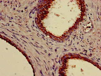 KRT18 / CK18 / Cytokeratin 18 Antibody - Immunohistochemistry of paraffin-embedded human prostate cancer using KRT18 Antibody, Biotin conjugated at dilution of 1:100